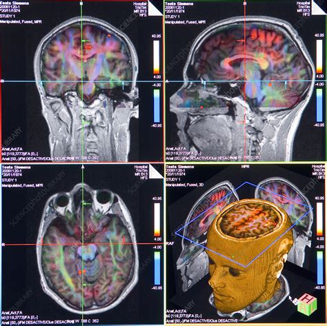 the villages mri brain scan|Advanced Imaging Centers .